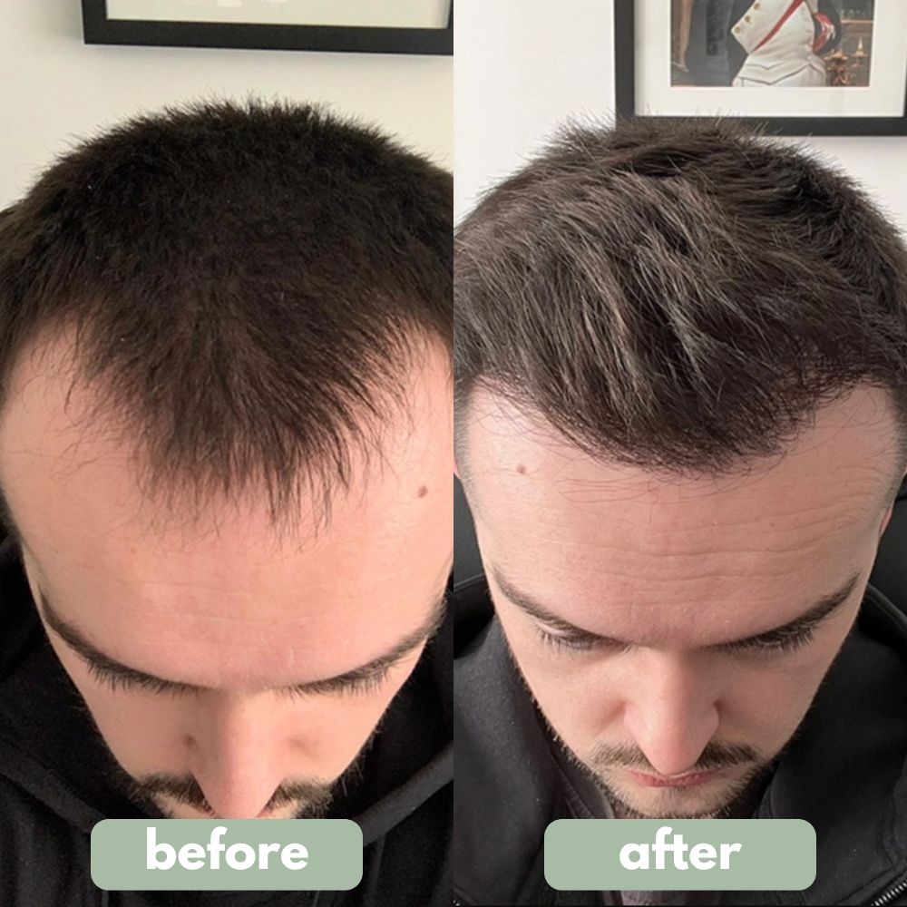 Growly - Hair growth serum